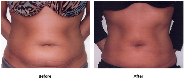 Liposuction vs. Tummy Tuck: Here's the Skinny – Mississauga Cosmetic Surgery  & Laser Clinic