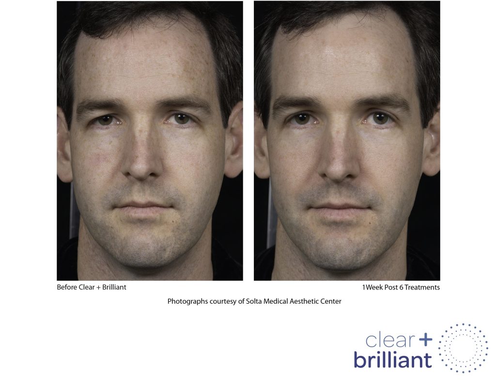 Clear + Brilliant laser skin treatment before and after - male patient face treatment