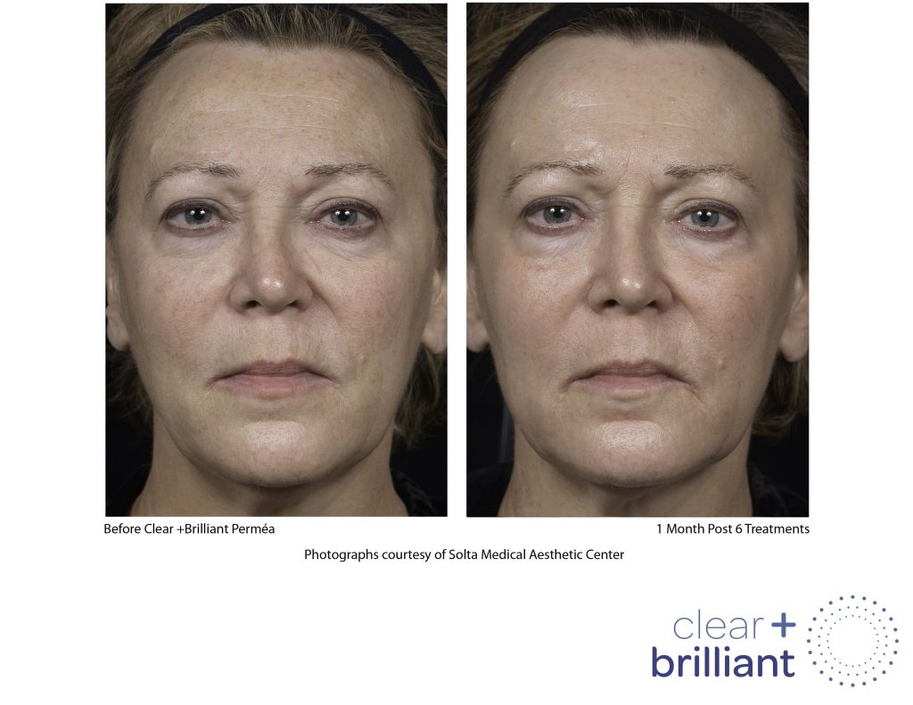 Clear + Brilliant laser skin treatment before and after - female patient face treatment